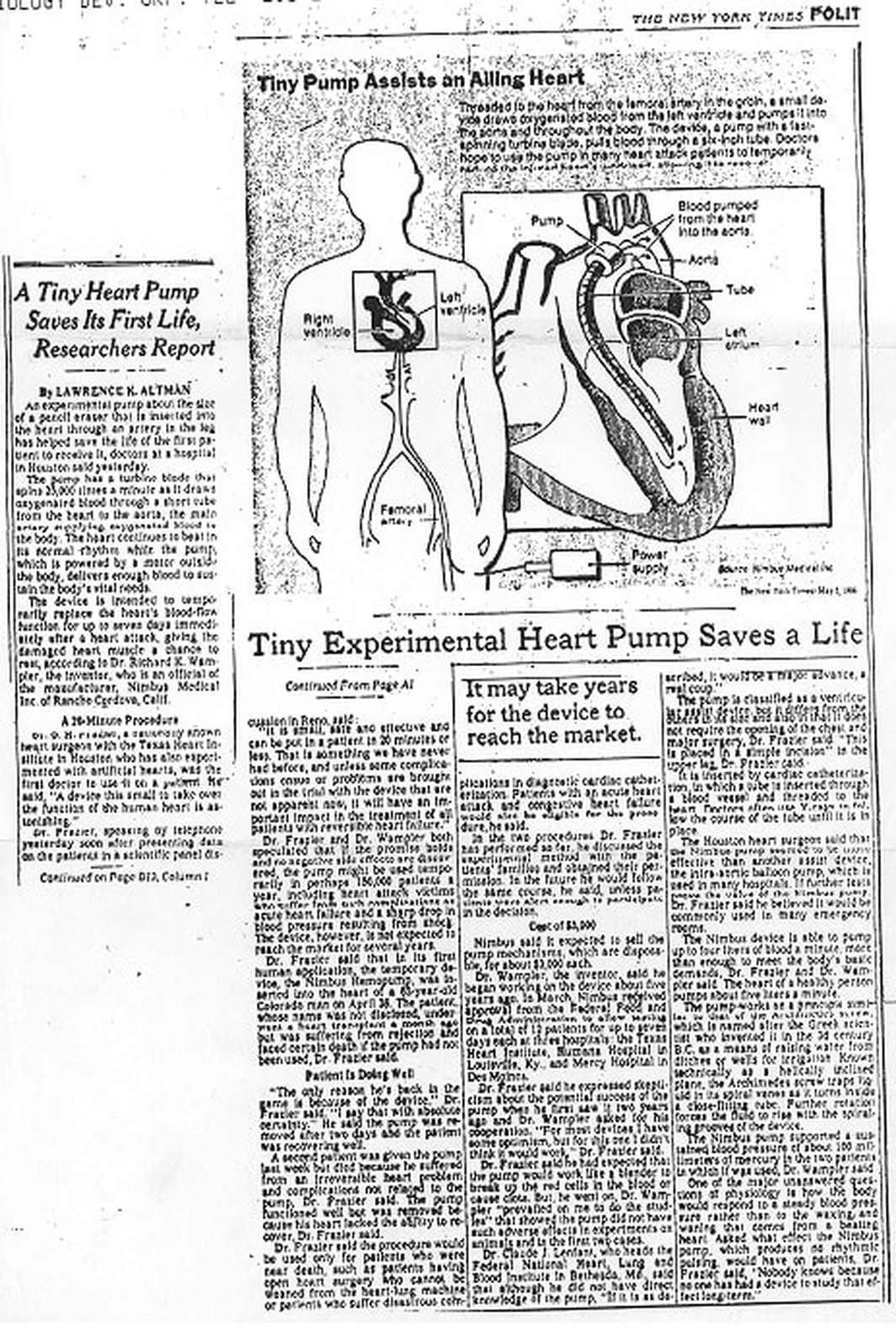 New York Times Article from May 5, 1988 on the Nimbus Hemopump